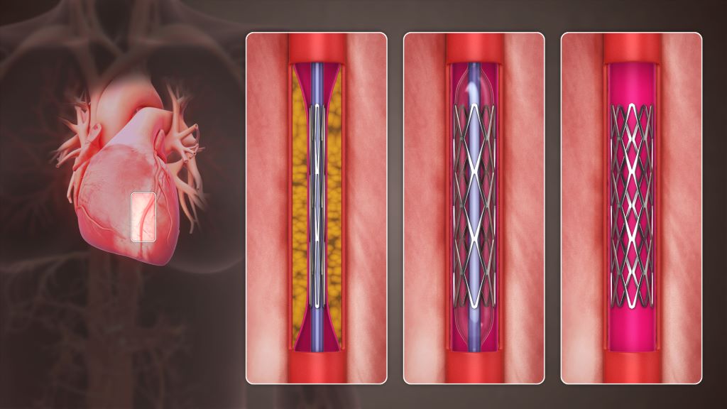 Percutaneous coronary intervention.